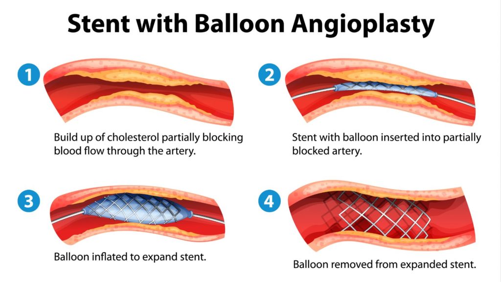 Stent angioplasty procedure